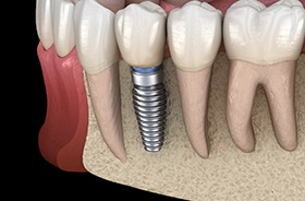 Dental implant integrated with jaw after bone graft