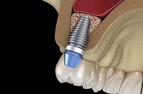 Illustration of implant in upper jaw after sinus lift