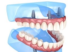 Illustration of All-on-4 for upper and lower arches