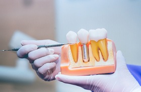 Dentist’s gloved hands holding model of dental implant