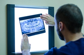 Dentist reviewing X-ray to determine if patient needs filling