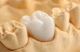 Dental crown restoration on smile model