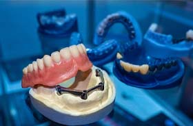 Implant denture resting on top of jawbone model