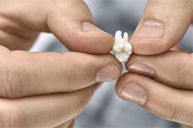 Hands holding extracted tooth between fingertips