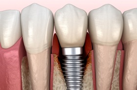 Illustration of peri-implantitis, a common cause of failed dental implants