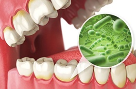 Illustration of plaque and bacteria along gumline