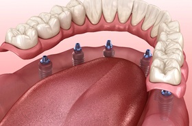 Illustration of implant denture supported by 6 dental implants