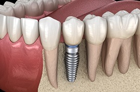 Diagram of single tooth dental implant in Branford