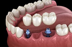 Diagram of dental implant bridge for missing teeth in Branford