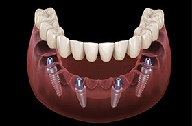 Diagram of implant dentures in Branford