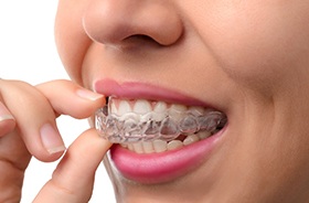 Close-up of woman’s mouth as she removes Invisalign aligner