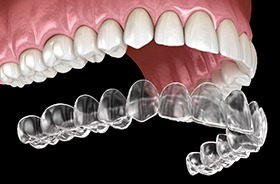 Illustration of Invisalign aligner being placed on teeth