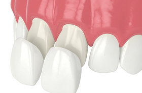 Porcelain veneers being placed on two front teeth