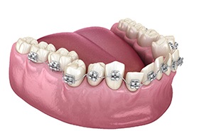 Illustration of crooked teeth with traditional metal braces