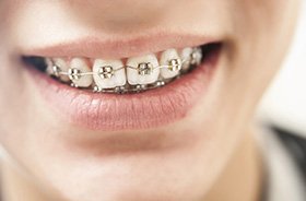 Close-up of young person’s smile with braces in Branford