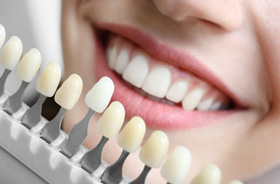 Dental shade guide next to patient’s teeth