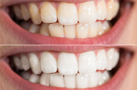 Close-up of person’s smile before and after teeth whitening