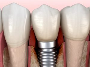 Illustration of loose dental implant, may have infection around it