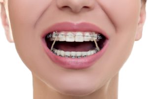 Close-up of woman’s smile with rubber bands on braces in Branford