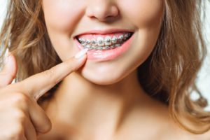 Woman smiling after addressing swollen gums with braces in Branford